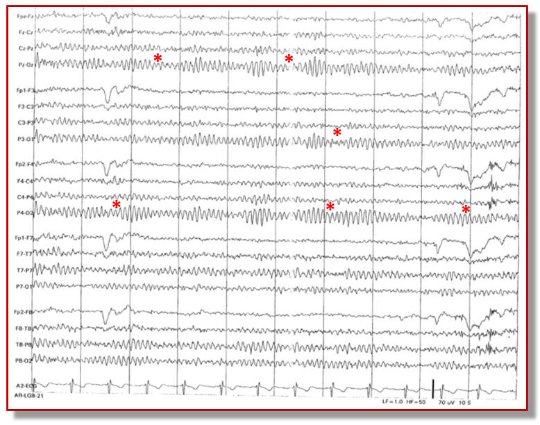 eeg